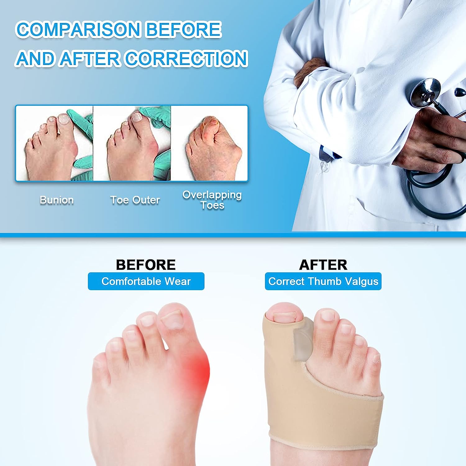Aeroflux© Premium Bunion Corrector: 1 Pair (2 Correctors)