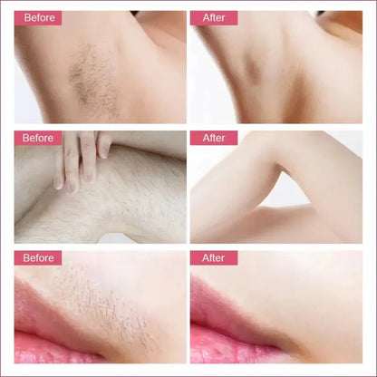 Aeroflux© Premium IPL Laser Hair Remover [Latest Technology + 1 Year Warranty]