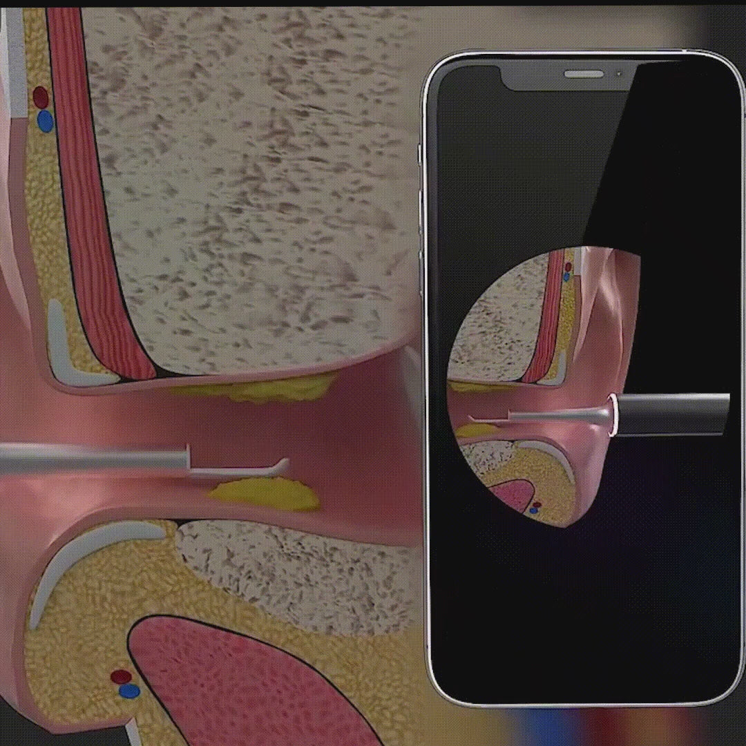 Load video: Aeroflux© XLife Smart Ear Cleaner Camera